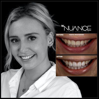 Customized tooth whitening protocols get results.