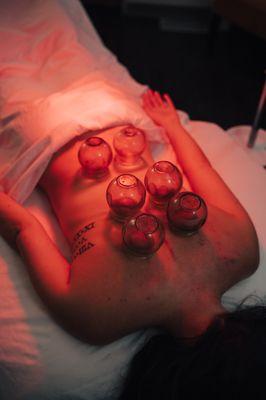 Fire cupping services provided in Acutherapy sessions and Comprehensive Acupuncture sessions