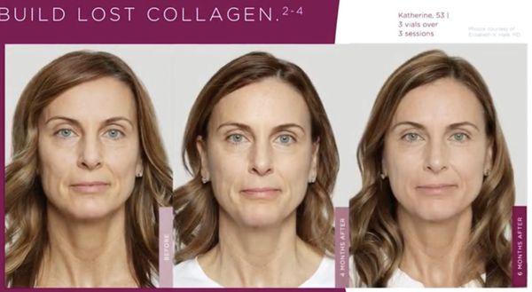 Sculptra - Collagen stimulator