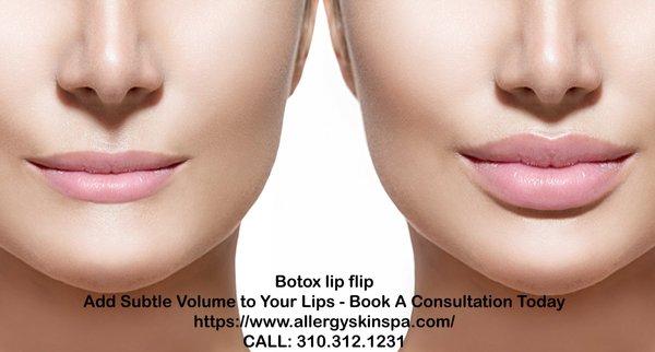 botox lip flip