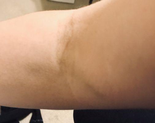 My veins after going to this place for blood work.