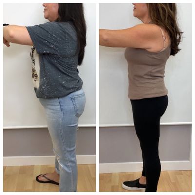 Before and After Semaglutide Weight-loss injections