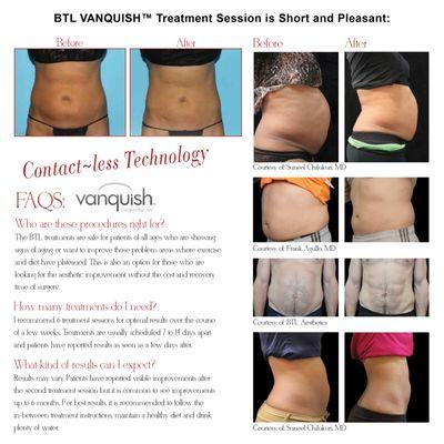 BTL VANQUISH™ Treatment Session is Short and Pleasant