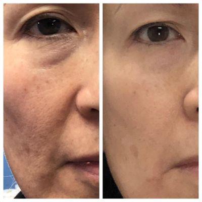 Before and After: TrueContour facial contouring  with 1 Limelight IPL PhotoFacial, and 3 Laser Genesis treatments.