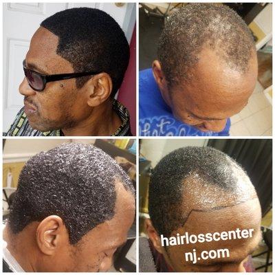 frontal hairline replacement