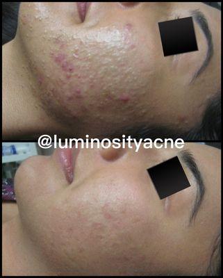 Acne Treatment results at Luminosity Acne Skincare.