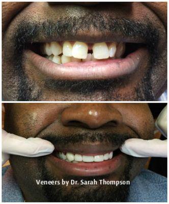 St. Louis area cosmetic dentist, Dr. Sarah Thompson placed several porcelain veneers for this patient.