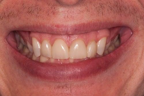 The same smile after our Emax Veneers.