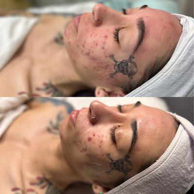 Before & After 
 client came in with cystic Acne & scaring these are results after just 3 sessions of Hydrofacial & LED Therapy