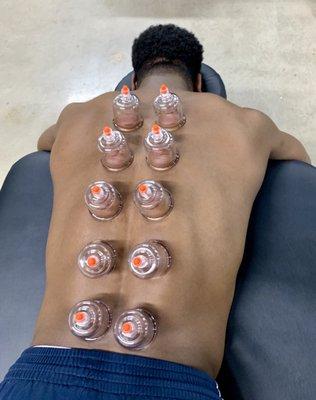 Cupping