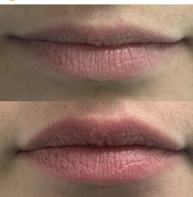 Natural Lip Plumping without fillers.