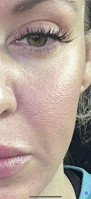 After microneedling. Enlarged pores, pits in face, ruined texture.