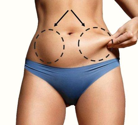 Liposuction