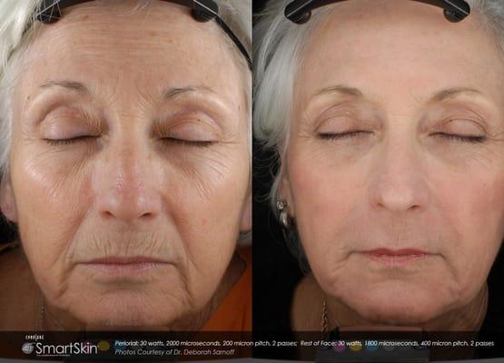 Before and After  SmartSkin CO2 Skin Renewal.