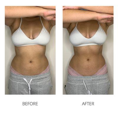 Body Sculpting results after one session