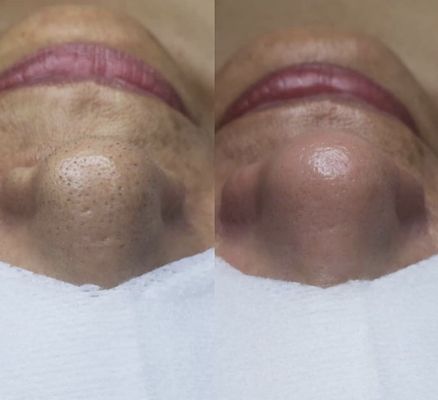 Before and after extractions