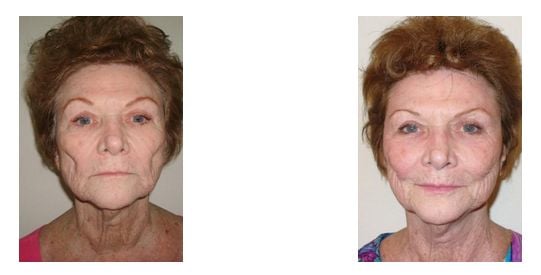 http://www.transformationsskincenter.com/Gallery.php  - Before and After photo of wrinkle reduction Charlotte, NC