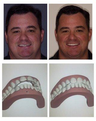 Invisalign before & after. Treatment time- 11months