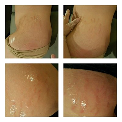 Radiofrequency for reduction of stretch marks