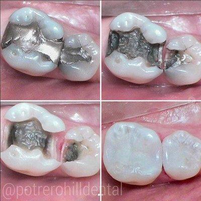 Old metal fillings were deteriorated and caused new decay. We use porcelain and tooth colored materials to make teeth look like teeth again.