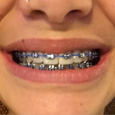 My braces