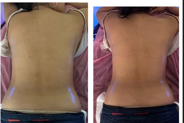 Before and After Back RF Skin Tightening