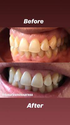 Before and after done by Luxury Smile Xpress.