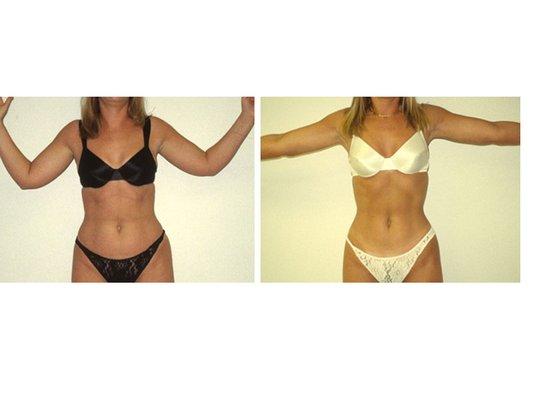 Liposuction Pre/post