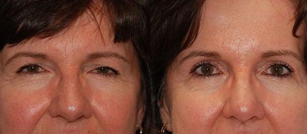 Eyelid Surgery