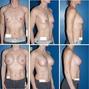 Breast Augmentation - Before & After