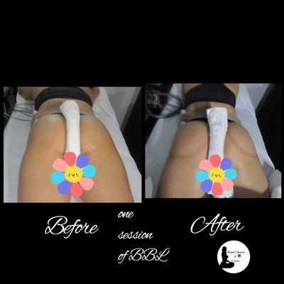 Non-Invasive Butt Lift before& after session