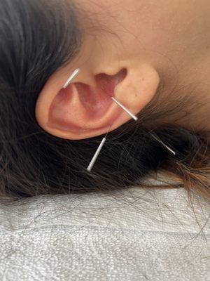 Amazing Auricular acupuncture