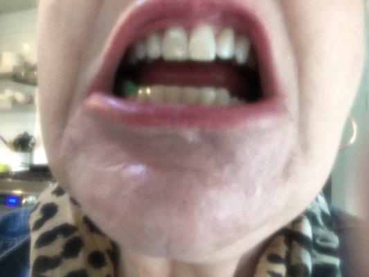 After: My chipped tooth is fixed and the taller tooth has been shortened to match the rest of my teeth.