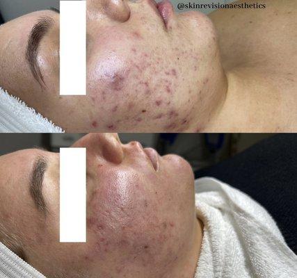 Before and after 4 sessions of chemical peels