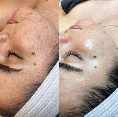 Before and after Microneedling/Chemical Peel Series