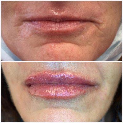 Before and after lip filler