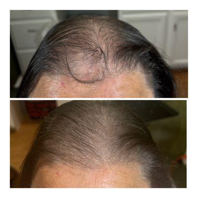 Before and After Scalp Micropigmentation