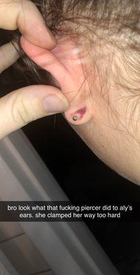 ear clamp bruise