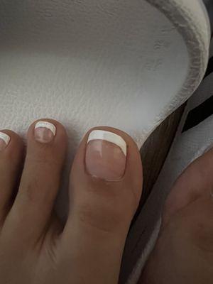 Bad pedicure