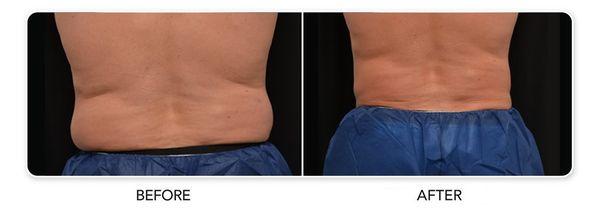 Before and after CoolSculpting® results on a male abdomen