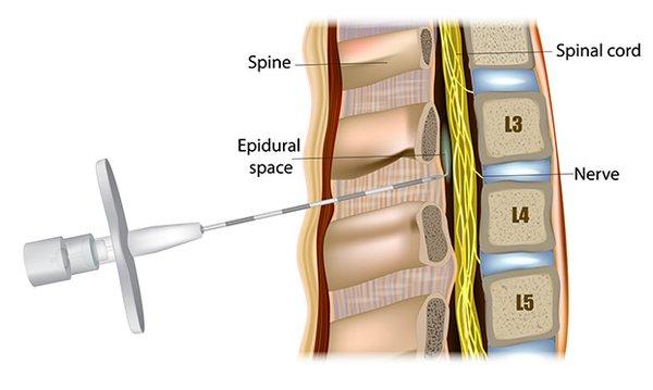 Provides an alternative intervention to interlaminar epidural injections to target radicular pain.