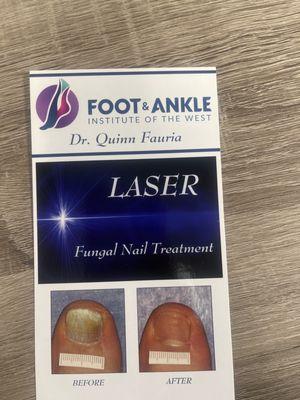 Laser for fungus toe nails. Recommend it 100%