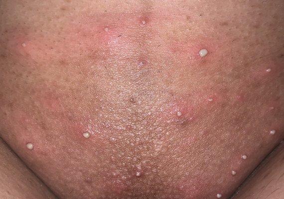 Severe reaction after wax, painful pustules and irritation