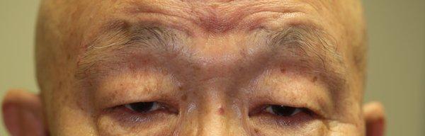 Before- Upper Blepharoplasty