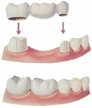 Missing a singular tooth?  An implant or bridge (illustrated above) an fill your gaps.