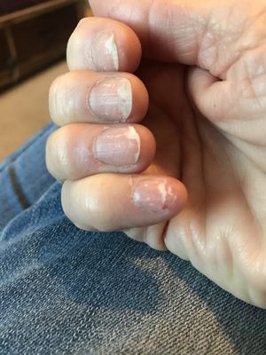 Fungus from Lotus Nail Salon Dip manicure