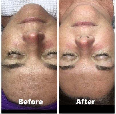 Opti Resurfacing Treatment with the Peptide Protein Mask