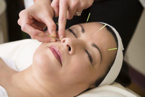 Facial Acupuncture helps minimize fine lines and wrinkles.