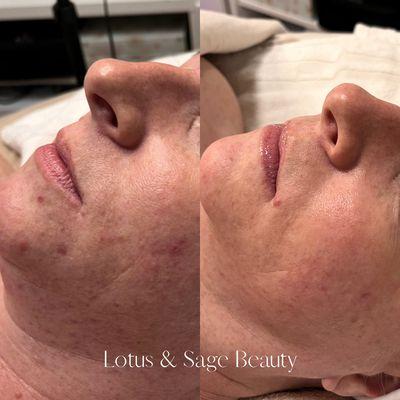 8 months microdermabrasion + peels progress