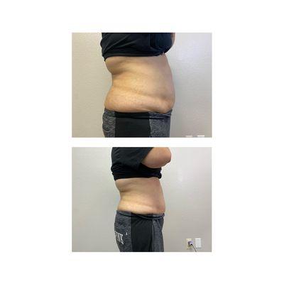 1 treatment of lipo cavitation